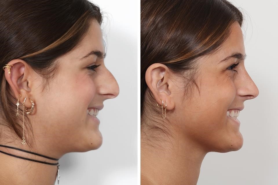 closed rhinoplasty cost