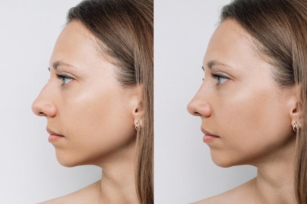 closed rhinoplasty recovery