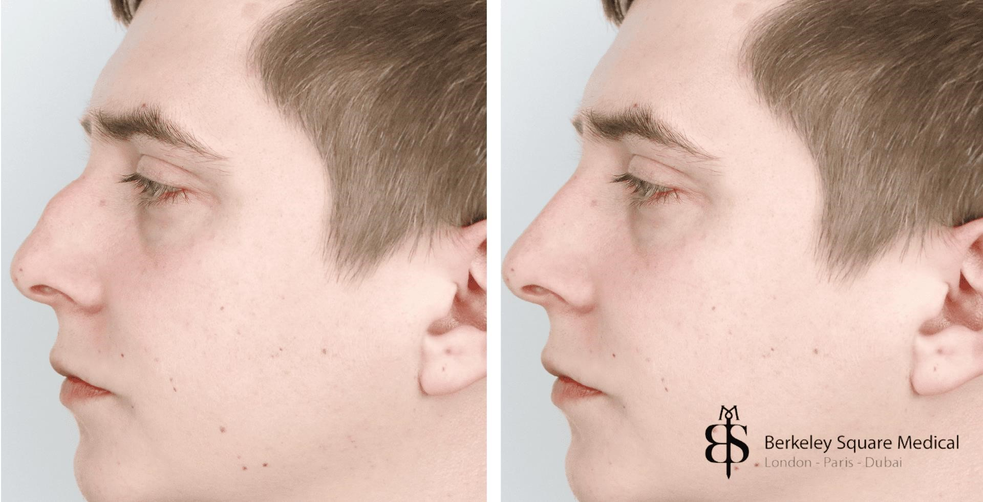 closed rhinoplasty recovery