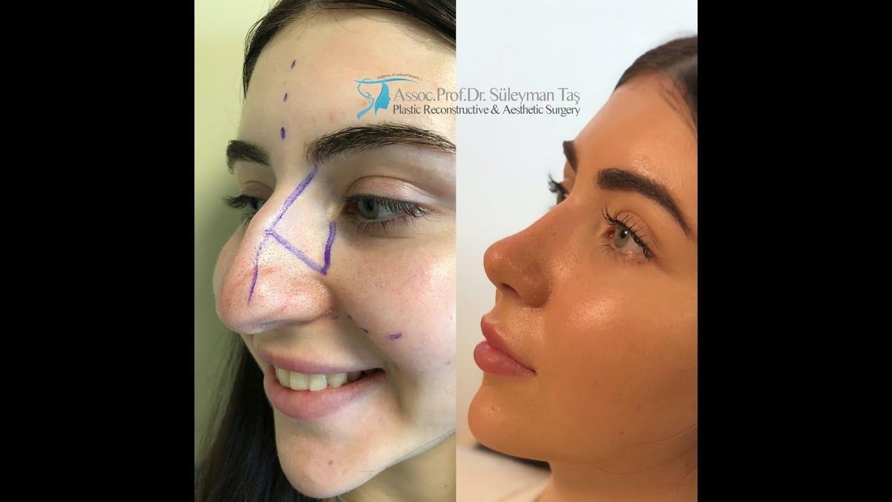 closed rhinoplasty cost