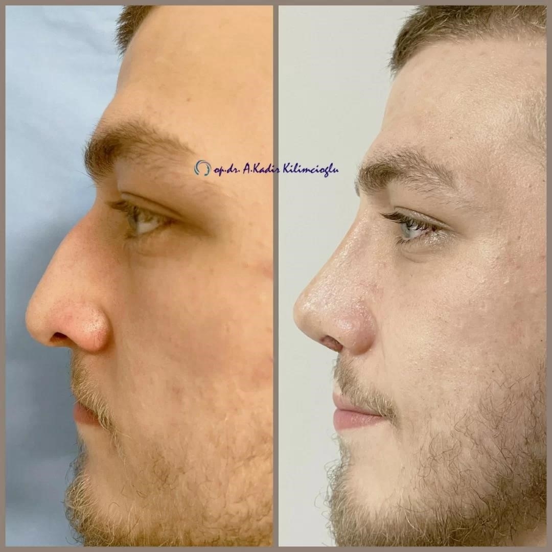 rhinoplasty surgeons