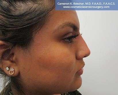 closed rhinoplasty recovery